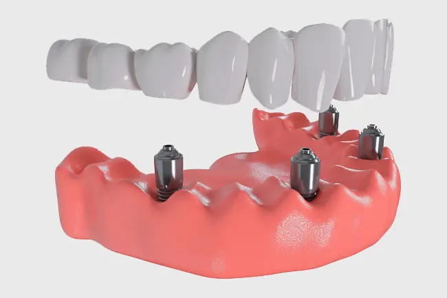 All-on-4 procedure is an option for restoring a full and permanent smile
