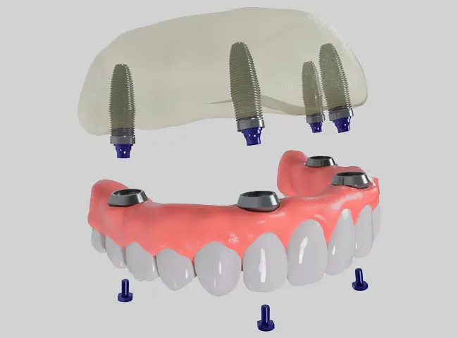 How Do All on 4 Dental Implants Work