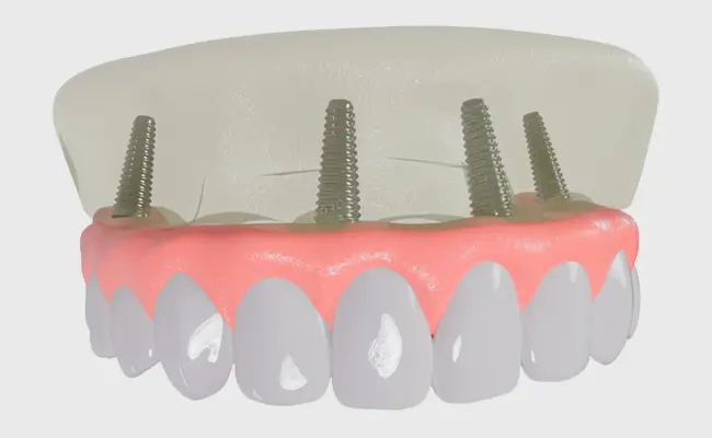 Titanium dental implant