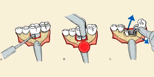 Sectioning a Tooth