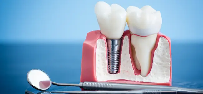Dental Implants