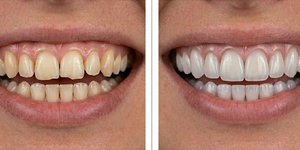 Porcelain Veneers